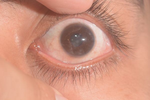 urgentna očesna stanja: keratitis